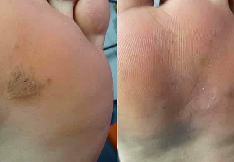 Verruca & Warts Treatments at MySkyn Clinic in Bradford