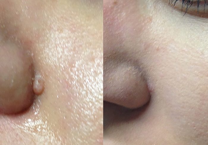 Mole Removal Treatment at MySkyn Clinic in Bradford