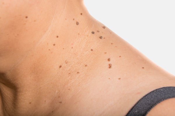 Treatments for skin tags at MySkyn Clinic in Bradford
