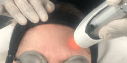 laser skin resurfacing Bradford