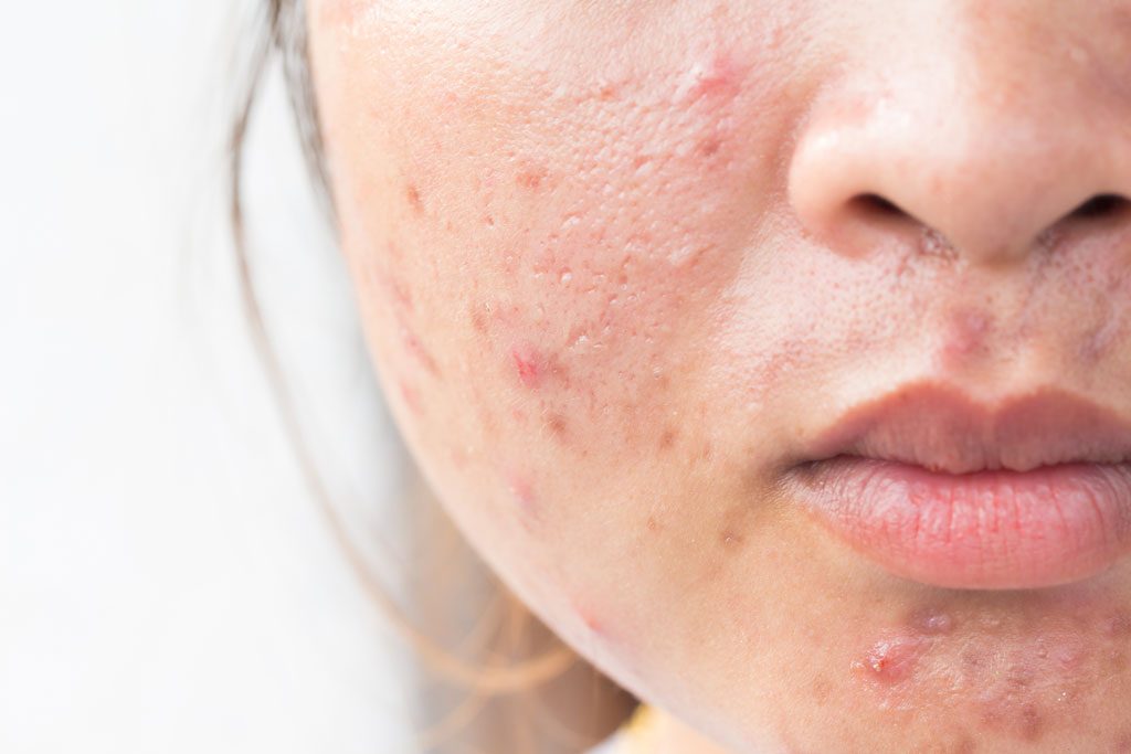 Acne scar removal treatments