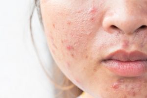 acne scar removal Bradford