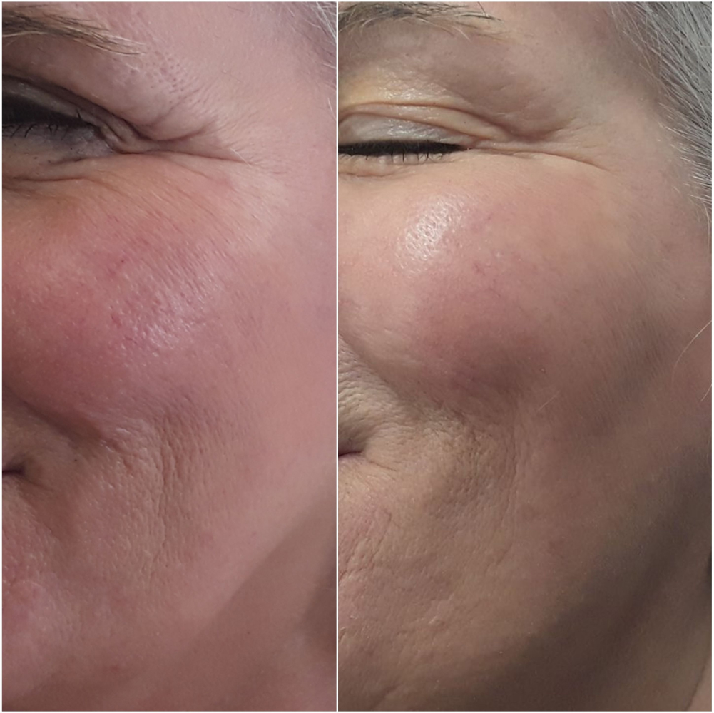 profile before and after