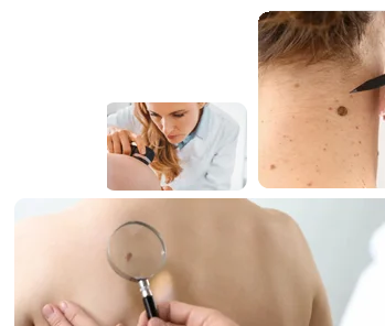 Skin Cancer Treatment Leeds