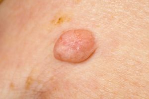 Lipoma Removal Leeds