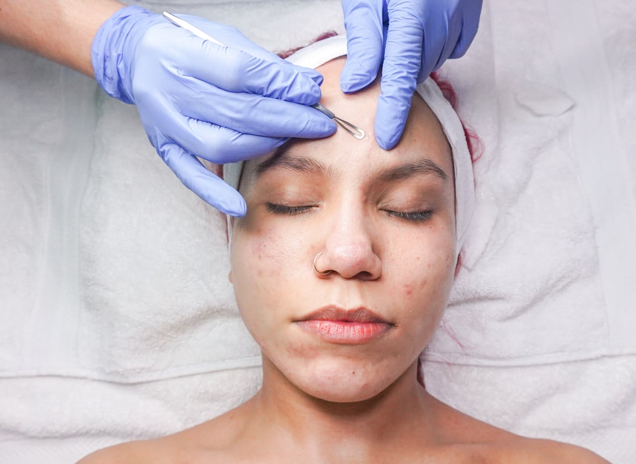 The Top Benefits of Professional Acne Treatments