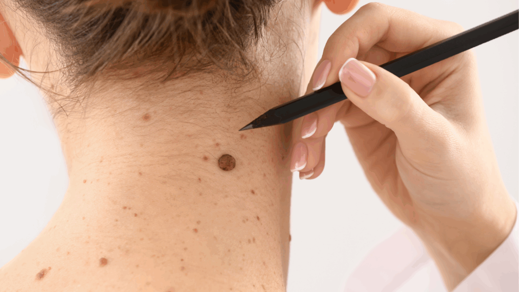 Skin Tag Removal